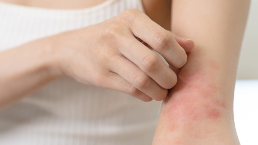 Eczema treatment
